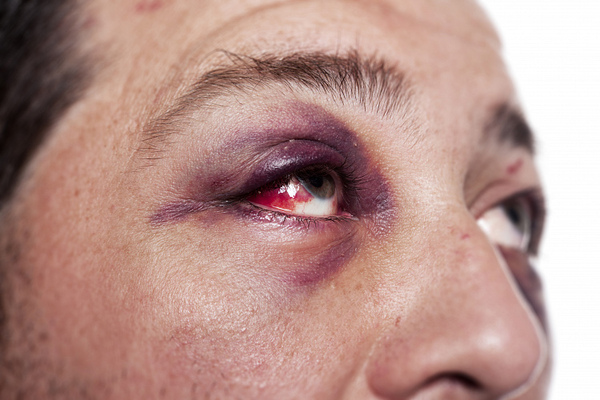 Кровоизлияние вокруг глаз 
 причины, способы диагностики и лечения thumbnail